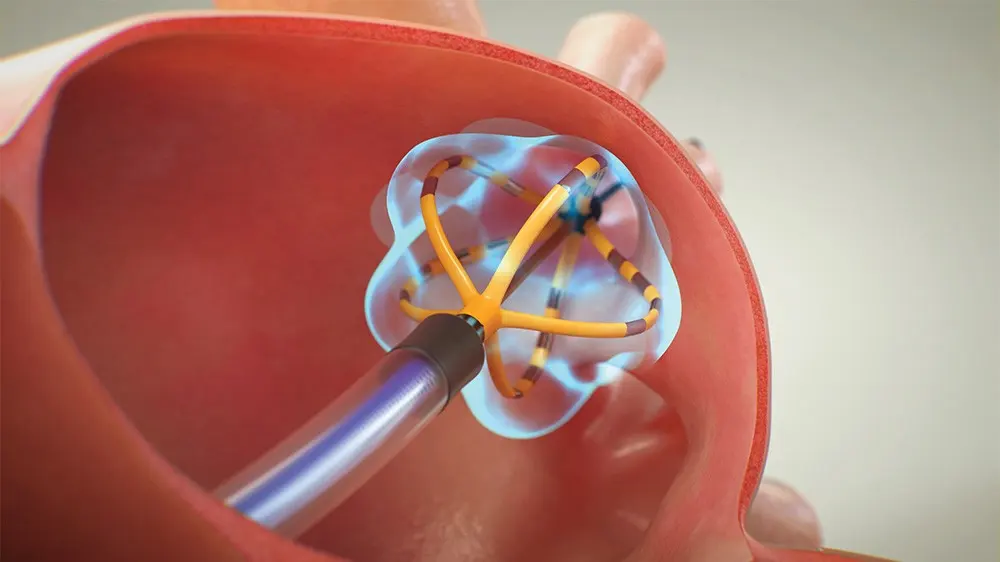 Rappresentazione grafica di un catetere da elettroporazione posto all`interno di una vena polmonare.