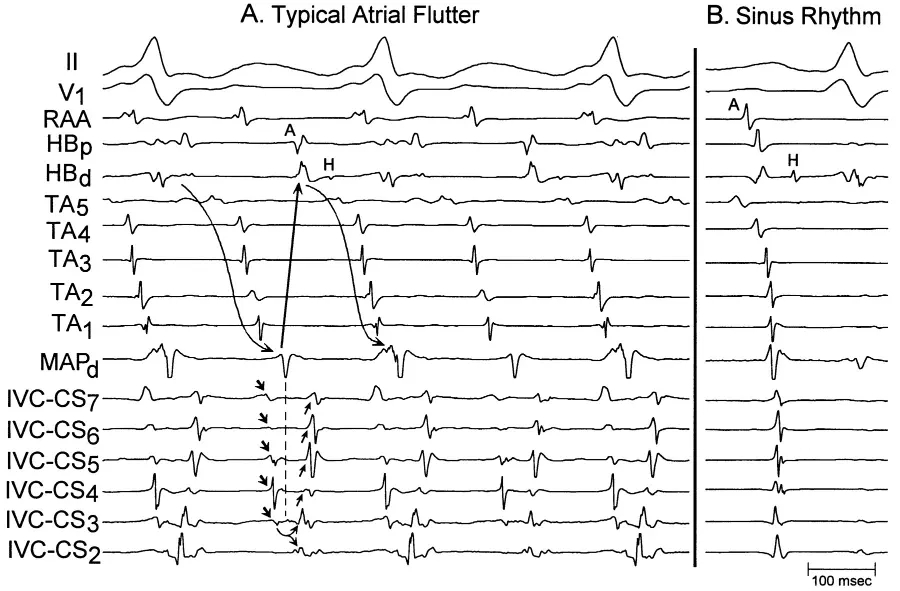Elettrocardiogramma endocavitario.